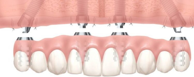 Protesi dentale immediata o temporanea: caratteristiche e vantaggi